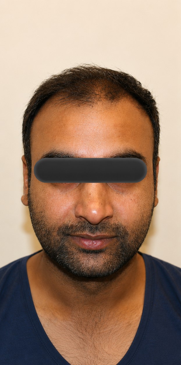 Scalp before hair transplant treatment at Dexa Clinic